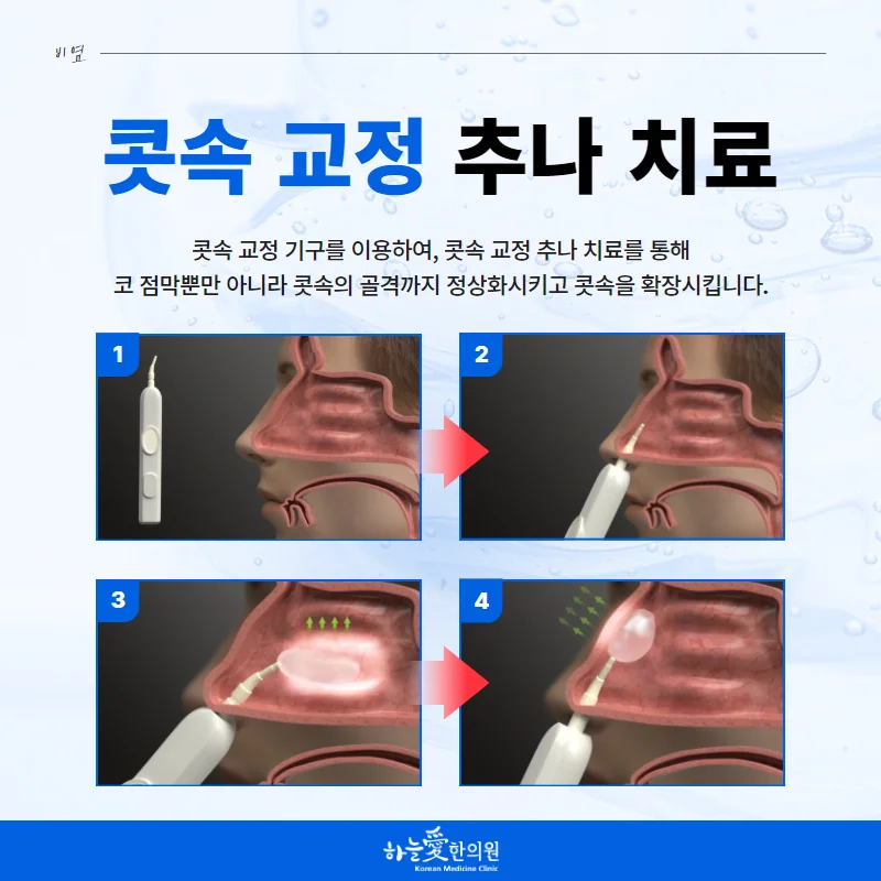 콧속 교정 기구로 콧속을 넓히는 콧속 교정 추나 치료 과정을 네 단계 그림으로 설명한 안내 이미지